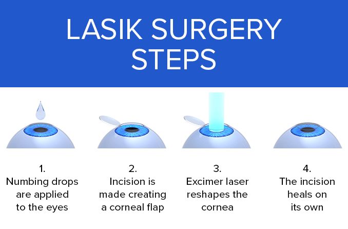 LASIK Eye Surgery