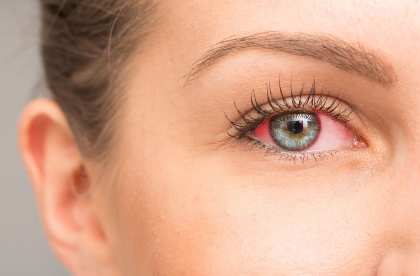 Behandlung trockener Augen: So beruhigen Sie gereizte Augen